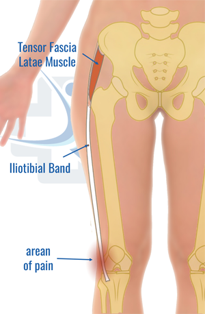 Iliotibial band syndrome (ITBS)