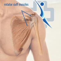 Rotator Cuff Tear - Perth Orthopaedic Specialist Centre